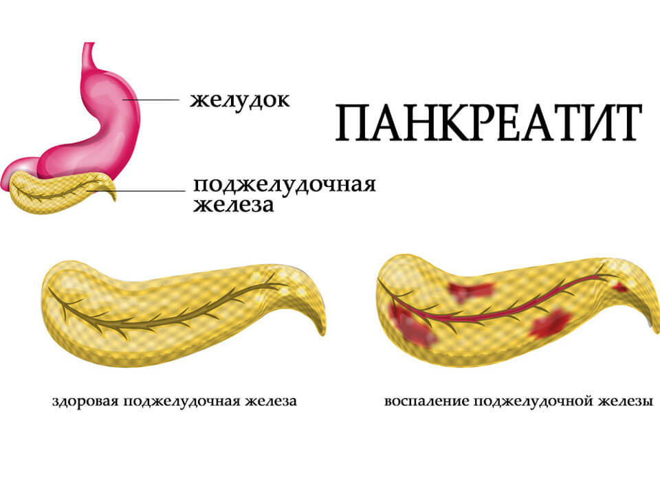 Воспаление поджелудочной железы